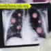 Chin o teisa choprobkha Pneumonia,rwjakha warning